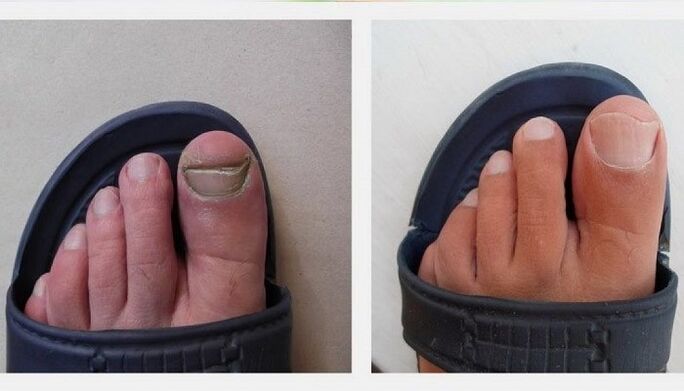 Tratament cu oțet ciuperca unghiilor de la picioare 70)